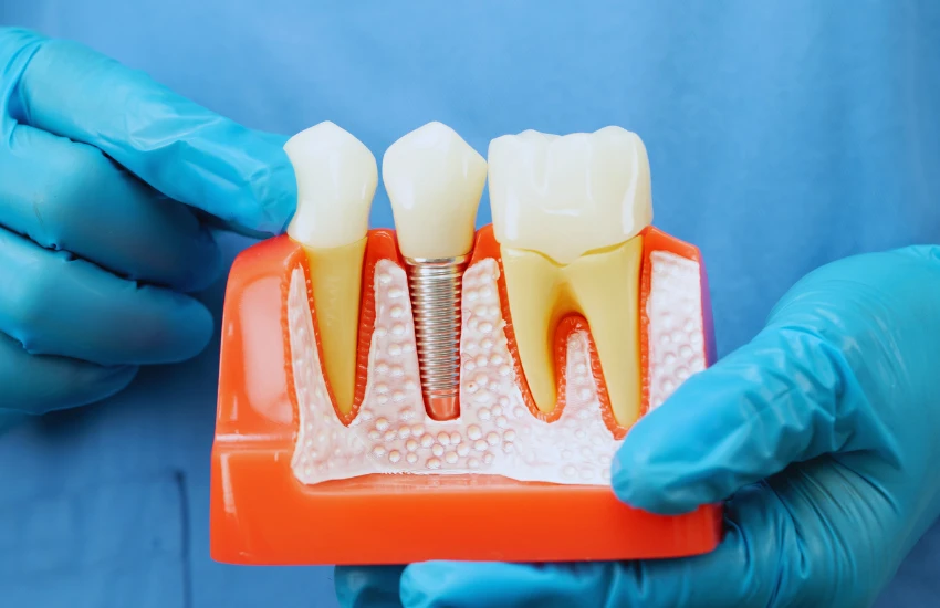 Implantes Dentários